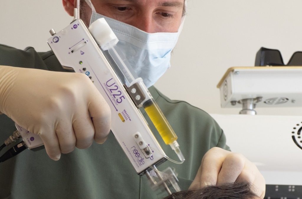 PRP capillaire : une solution naturelle contre la chute de cheveux