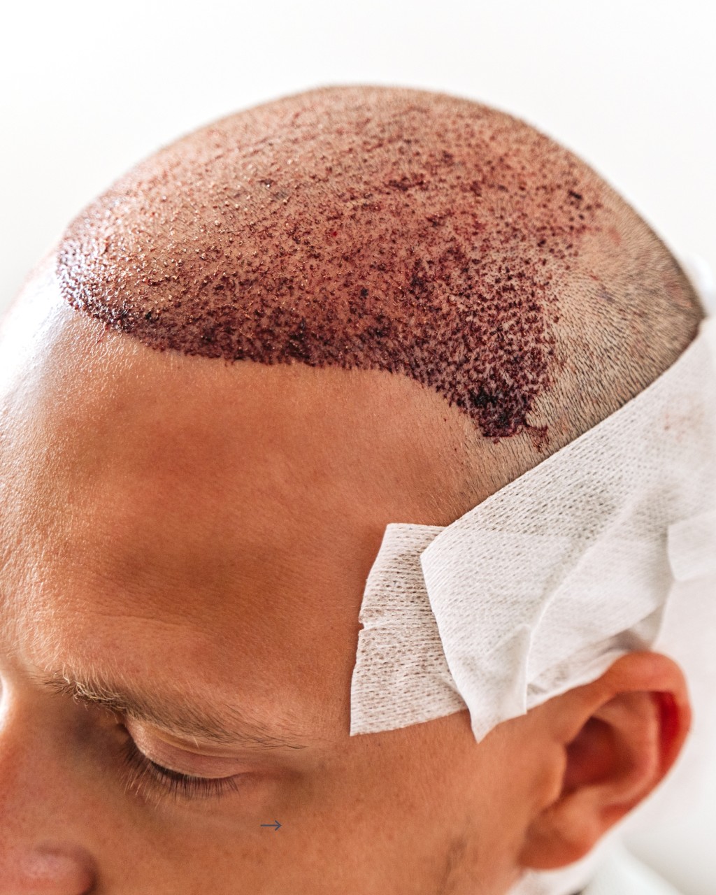 Injections-penis-Homme-Aix