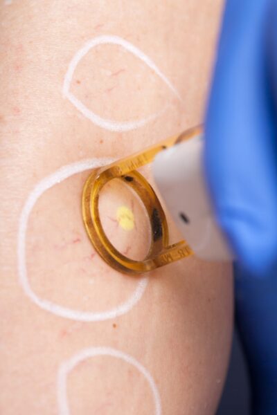 Laser vasculaire à Aix en Provence