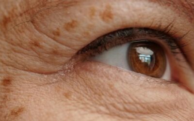 Taches brunes : les beaux jours arrivent… et si c’était le moment de faire le point sur votre peau ?