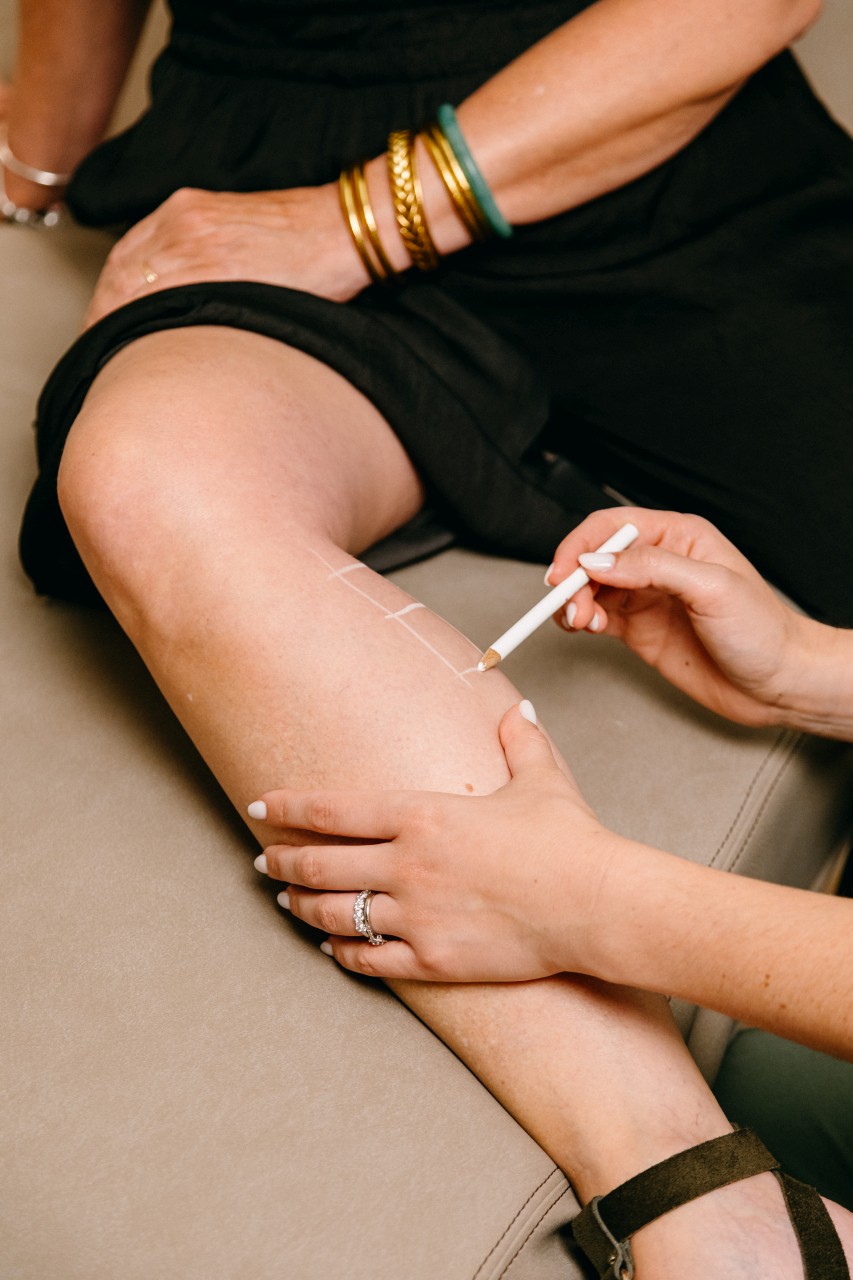 Laser vasculaire pour traiter la Varicosités des jambes